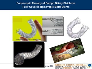 ENDOSCOPIA DIGESTIVA CHIRURGICA
UNIVERSITA’ CATTOLICA DEL SACRO CUORE
EUROPEAN ENDOSCOPY TRAINING CENTRE
Endoscopic Therapy of Benign Biliary Strictures
Fully Covered Removable Metal Stents
 
