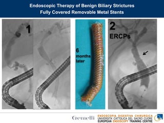 ENDOSCOPIA DIGESTIVA CHIRURGICA
UNIVERSITA’ CATTOLICA DEL SACRO CUORE
EUROPEAN ENDOSCOPY TRAINING CENTRE
1 2
ERCPs
6
months
later
Endoscopic Therapy of Benign Biliary Strictures
Fully Covered Removable Metal Stents
 