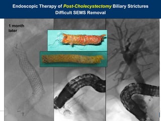 ENDOSCOPIA DIGESTIVA CHIRURGICA
UNIVERSITA’ CATTOLICA DEL SACRO CUORE
EUROPEAN ENDOSCOPY TRAINING CENTRE
After
10 months
12 mm
Endoscopic Therapy of Post-Cholecystectomy Biliary Strictures
Difficult SEMS Removal
2 months
later SEMS in SEMS
1 month
later
 