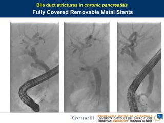 ENDOSCOPIA DIGESTIVA CHIRURGICA
UNIVERSITA’ CATTOLICA DEL SACRO CUORE
EUROPEAN ENDOSCOPY TRAINING CENTRE
Bile duct strictures in chronic pancreatitis
Fully Covered Removable Metal Stents
 