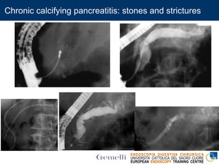 ENDOSCOPIA DIGESTIVA CHIRURGICA
UNIVERSITA’ CATTOLICA DEL SACRO CUORE
EUROPEAN ENDOSCOPY TRAINING CENTRE
Chronic calcifying pancreatitis: stones and strictures
 