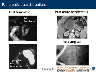ENDOSCOPIA DIGESTIVA CHIRURGICA
UNIVERSITA’ CATTOLICA DEL SACRO CUORE
EUROPEAN ENDOSCOPY TRAINING CENTRE
Pancreatic duct disruption.
Post traumatic Post acute pancreatitis
Post surgical
Fall
from horse
7 years old
Fall
from bicicle
 