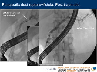 ENDOSCOPIA DIGESTIVA CHIRURGICA
UNIVERSITA’ CATTOLICA DEL SACRO CUORE
EUROPEAN ENDOSCOPY TRAINING CENTRE
Pancreatic duct rupture+fistula. Post traumatic.
7 French, 9 cm
After 2 months
LM, 23 years old,
car accident.
 