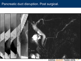 ENDOSCOPIA DIGESTIVA CHIRURGICA
UNIVERSITA’ CATTOLICA DEL SACRO CUORE
EUROPEAN ENDOSCOPY TRAINING CENTRE
8.5 French
After 10 French stent
Pancreatic duct disruption. Post surgical.
 
