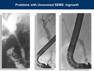 Problems with Uncovered SEMS: Ingrowth
 