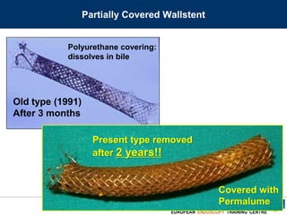 ENDOSCOPIA DIGESTIVA CHIRURGICA
UNIVERSITA’ CATTOLICA DEL SACRO CUORE
EUROPEAN ENDOSCOPY TRAINING CENTRE
Partially Covered Wallstent
Old type (1991)
After 3 months
Polyurethane covering:
dissolves in bile
Present type removed
after 2 years!!
Covered with
Permalume
 