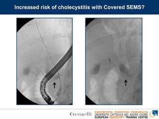 ENDOSCOPIA DIGESTIVA CHIRURGICA
UNIVERSITA’ CATTOLICA DEL SACRO CUORE
EUROPEAN ENDOSCOPY TRAINING CENTRE
Increased risk of cholecystitis with Covered SEMS?
 