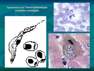 Trypanosoma cruzi :  forma tripomastigota circulante y amastigote 