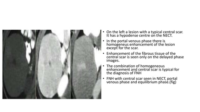 Triphasic CT scan | PPTX