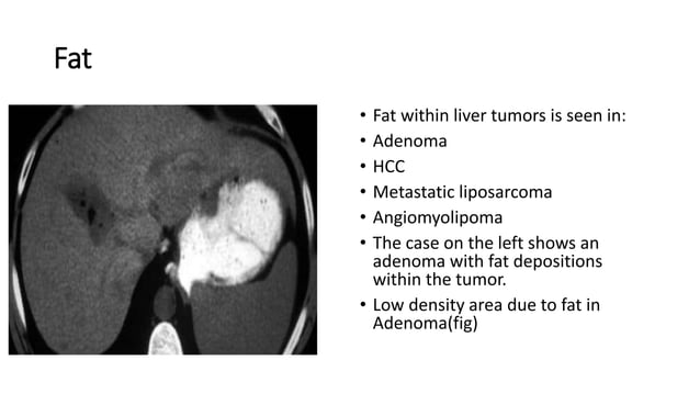 Triphasic CT scan | PPTX