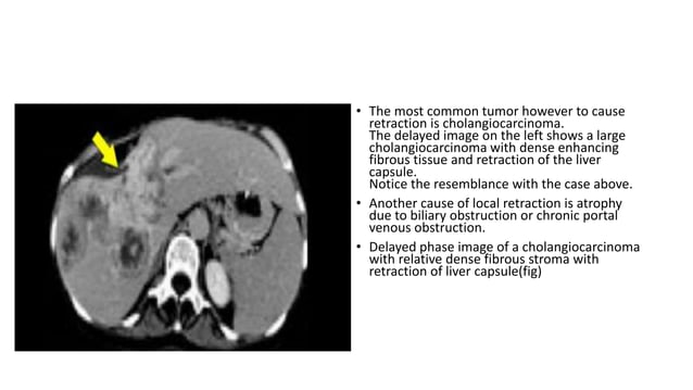Triphasic CT scan | PPTX