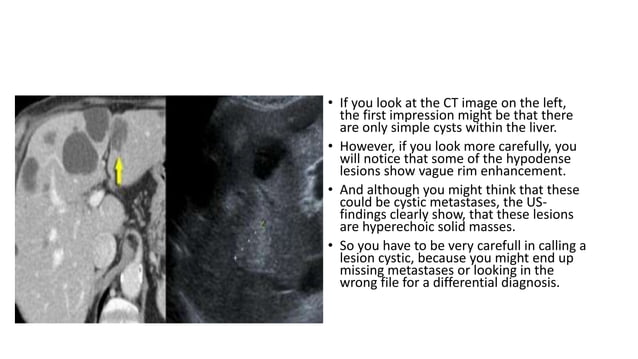 Triphasic CT scan