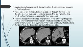 Absccess Triphasic Ct Scan Triphasic CT Scan of Liver radiology.pptx