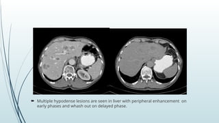 Absccess Triphasic Ct Scan Triphasic CT Scan of Liver radiology.pptx