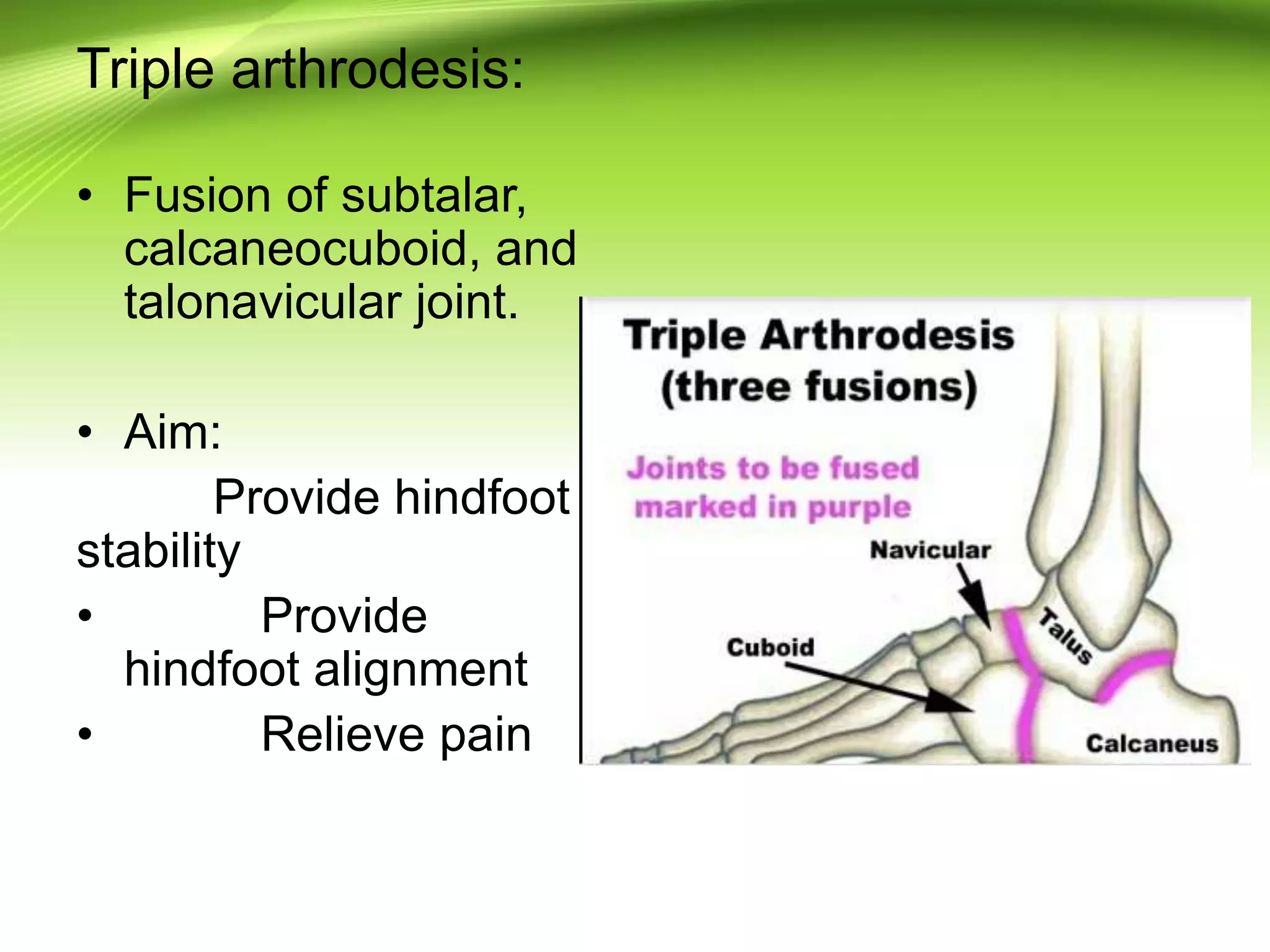 Triple arthrodesis:
• Fusion of subtalar,
calcaneocuboid, and
talonavicular joint.
• Aim:
Provide hindfoot
stability
• Provide
hindfoot alignment
• Relieve pain
 