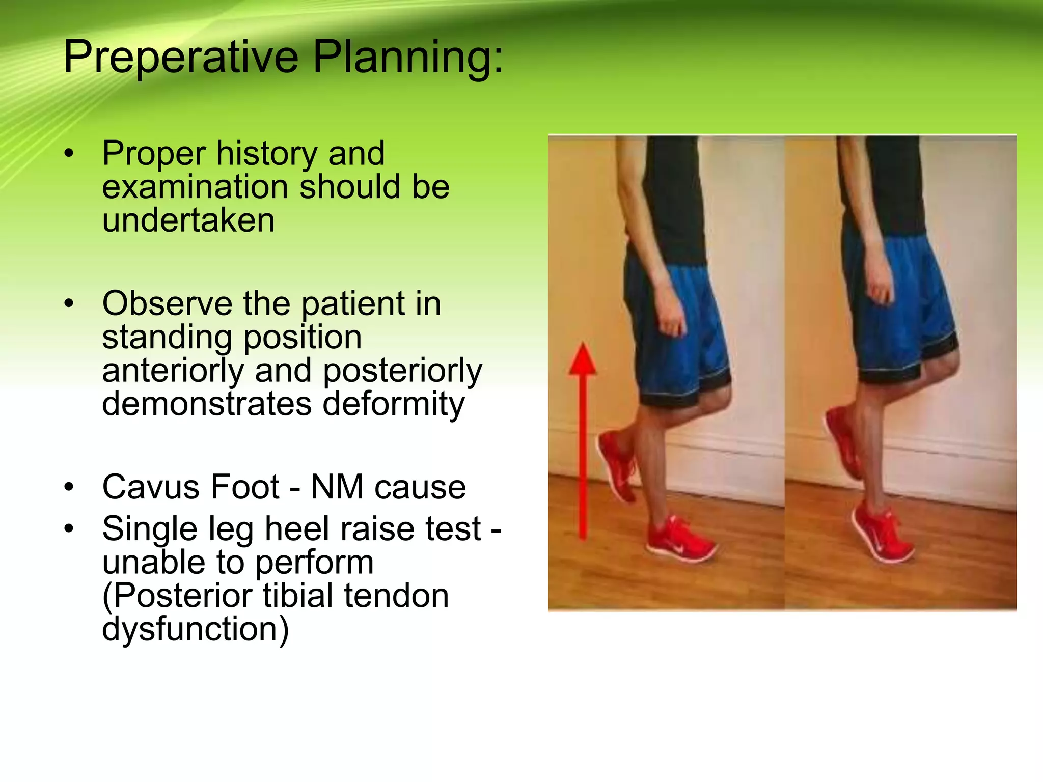 Preperative Planning:
• Proper history and
examination should be
undertaken
• Observe the patient in
standing position
anteriorly and posteriorly
demonstrates deformity
• Cavus Foot - NM cause
• Single leg heel raise test -
unable to perform
(Posterior tibial tendon
dysfunction)
 