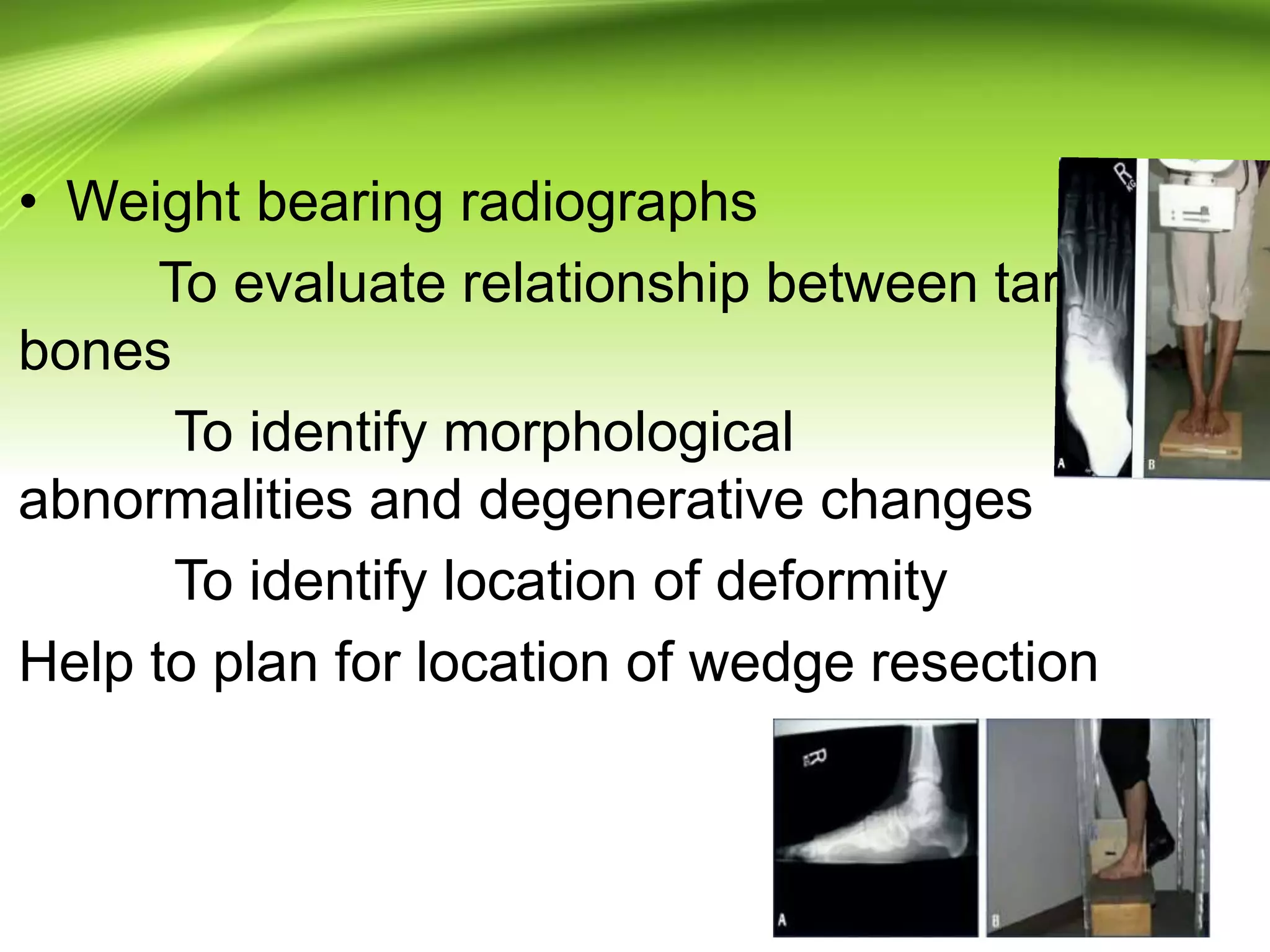 • Weight bearing radiographs
To evaluate relationship between tarsal
bones
To identify morphological
abnormalities and degenerative changes
To identify location of deformity
Help to plan for location of wedge resection
 