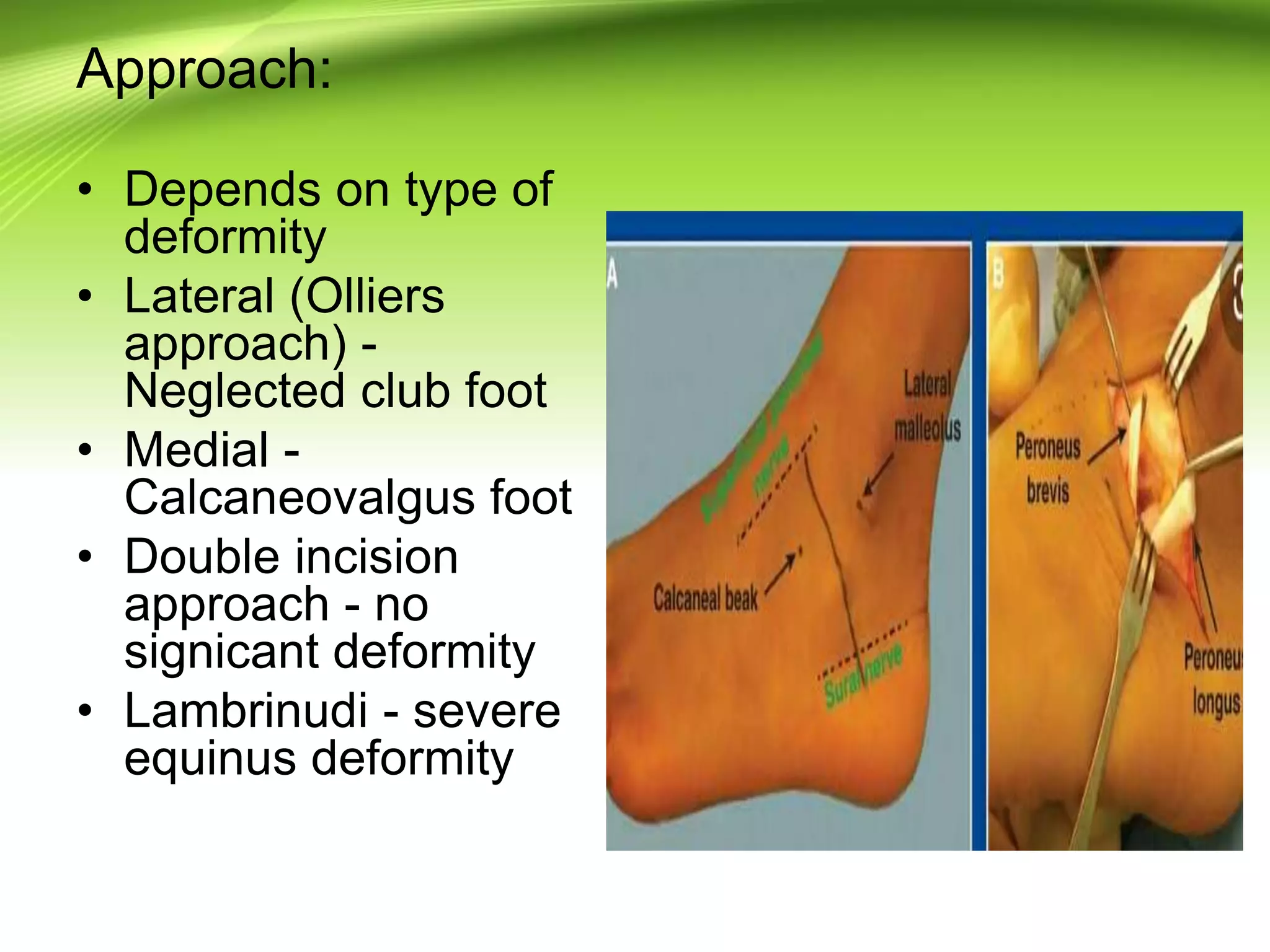 Approach:
• Depends on type of
deformity
• Lateral (Olliers
approach) -
Neglected club foot
• Medial -
Calcaneovalgus foot
• Double incision
approach - no
signicant deformity
• Lambrinudi - severe
equinus deformity
 