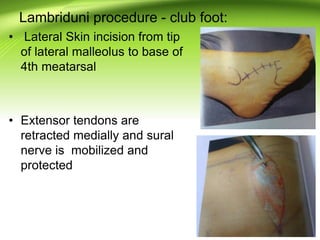Lambriduni procedure - club foot:
• Lateral Skin incision from tip
of lateral malleolus to base of
4th meatarsal
• Extensor tendons are
retracted medially and sural
nerve is mobilized and
protected
 