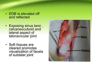 • EDB is elevated off
and reflected
• Exposing sinus tarsi ,
calcaneocuboid and
lateral aspect of
talonavicular joint
• Soft tissues are
cleared promotes
visualization of facets
of subtalar joint
 
