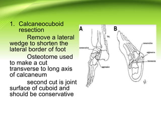 1. Calcaneocuboid
resection
Remove a lateral
wedge to shorten the
lateral border of foot
Osteotome used
to make a cut
transverse to long axis
of calcaneum
second cut is joint
surface of cuboid and
should be conservative
 
