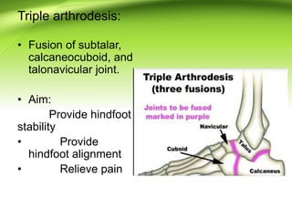 Triple arthrodesis:
• Fusion of subtalar,
calcaneocuboid, and
talonavicular joint.
• Aim:
Provide hindfoot
stability
• Provide
hindfoot alignment
• Relieve pain
 
