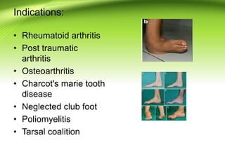 Indications:
• Rheumatoid arthritis
• Post traumatic
arthritis
• Osteoarthritis
• Charcot's marie tooth
disease
• Neglected club foot
• Poliomyelitis
• Tarsal coalition
 