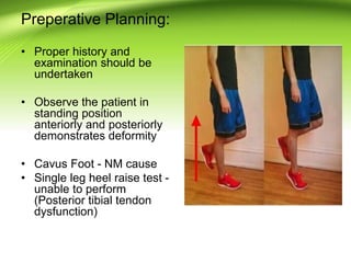 Preperative Planning:
• Proper history and
examination should be
undertaken
• Observe the patient in
standing position
anteriorly and posteriorly
demonstrates deformity
• Cavus Foot - NM cause
• Single leg heel raise test -
unable to perform
(Posterior tibial tendon
dysfunction)
 