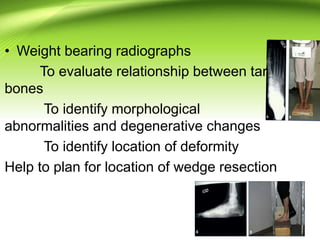 • Weight bearing radiographs
To evaluate relationship between tarsal
bones
To identify morphological
abnormalities and degenerative changes
To identify location of deformity
Help to plan for location of wedge resection
 