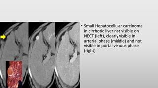 • Small Hepatocellular carcinoma
in cirrhotic liver not visible on
NECT (left), clearly visible in
arterial phase (middle) and not
visible in portal venous phase
(right)
 