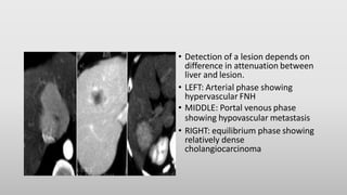 • Detection of a lesion depends on
difference in attenuation between
liver and lesion.
• LEFT: Arterial phase showing
hypervascular FNH
• MIDDLE: Portal venous phase
showing hypovascular metastasis
• RIGHT: equilibrium phase showing
relatively dense
cholangiocarcinoma
 