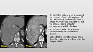 • On the left a patient who underwent
two phases of arterial imaging at 18
and 35 seconds. In the early arterial
phase we nicely see the arteries, but
we only see some irregular
enhancement within the liver.
• In the late arterial phase we can
clearly identify multiple tumor
masses.
• Notice that in the late arterial phase
there has to be some enhancement of
the portal vein.
 
