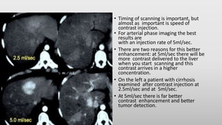 • Timing of scanning is important, but
almost as important is speed of
contrast injection.
• For arterial phase imaging the best
results are
with an injection rate of 5ml/sec.
• There are two reasons for this better
enhancement: at 5ml/sec there will be
more contrast delivered to the liver
when you start scanning and this
contrast arrives in a higher
concentration.
• On the left a patient with cirrhosis
examined after contrast injection at
2.5ml/sec and at 5ml/sec.
• At 5ml/sec there is far better
contrast enhancement and better
tumor detection.
 