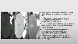 • On the left a lesion with a typical central
scar. It has a hypodense centre on the
NECT.
• In the portal venous phase there is
homogeneus enhancement of the
lesion except for the scar.
• Enhancement of the fibrous tissue of the
central scar is seen only on the delayed
phase images.
• The combination of homogeneous
enhancement and central scar is
typical for the diagnosis of FNH
• FNH with central scar seen in NECT,
portal venous phase and equilibrium
phase.(fig)
 