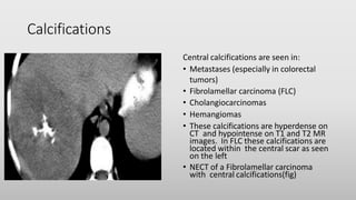 Calcifications
Central calcifications are seen in:
• Metastases (especially in colorectal
tumors)
• Fibrolamellar carcinoma (FLC)
• Cholangiocarcinomas
• Hemangiomas
• These calcifications are hyperdense on
CT and hypointense on T1 and T2 MR
images. In FLC these calcifications are
located within the central scar as seen
on the left
• NECT of a Fibrolamellar carcinoma
with central calcifications(fig)
 