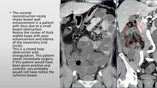 • The coronal
reconstruction nicely
shows bowel wall
enhancement in a patient
with ileus due to a small
bowel obstruction.
Notice the cluster of thick
walled loops with poor
enhancement and edema
of the mesentery (red
circle).
This is a closed loop
obstruction with
strangulation. This patient
needs immediate surgery.
If this patient would have
been given positive oral
contrast, you probably
would not have notice the
ischemic bowel.
 