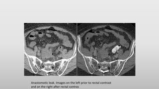 Anastomotic leak. Images on the left prior to rectal contrast
and on the right after rectal contras
 