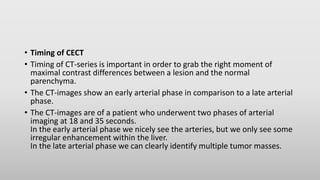 • Timing of CECT
• Timing of CT-series is important in order to grab the right moment of
maximal contrast differences between a lesion and the normal
parenchyma.
• The CT-images show an early arterial phase in comparison to a late arterial
phase.
• The CT-images are of a patient who underwent two phases of arterial
imaging at 18 and 35 seconds.
In the early arterial phase we nicely see the arteries, but we only see some
irregular enhancement within the liver.
In the late arterial phase we can clearly identify multiple tumor masses.
 