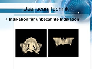 Dual scan Technik
• Indikation für unbezahnte Indikation
 