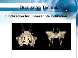 Dual scan Technik
• Indikation für unbezahnte Indikation
 