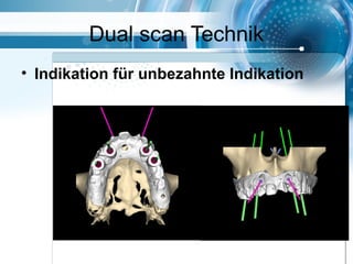 Dual scan Technik
• Indikation für unbezahnte Indikation
 