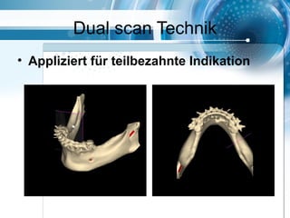 Dual scan Technik
• Appliziert für teilbezahnte Indikation
 