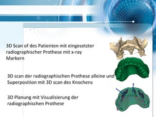 3D Planung mit Visualisierung der
radiographischen Prothese
3D scan der radiographischen Prothese alleine und
Superposition mit 3D scan des Knochens
3D Scan of des Patienten mit eingesetzter
radiographischer Prothese mit x-ray
Markern
 