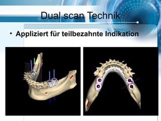Dual scan Technik
• Appliziert für teilbezahnte Indikation
 