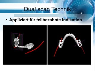 Dual scan Technik
• Appliziert für teilbezahnte Indikation
 