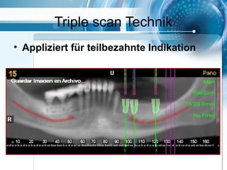 Triple scan Technik
• Appliziert für teilbezahnte Indikation
 