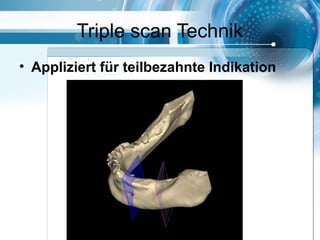 Triple scan Technik
• Appliziert für teilbezahnte Indikation
 