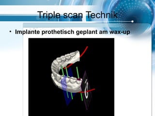 Triple scan Technik
• Implante prothetisch geplant am wax-up
 