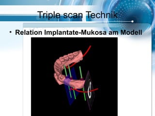 Triple scan Technik
• Relation Implantate-Mukosa am Modell
 