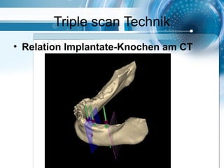 Triple scan Technik
• Relation Implantate-Knochen am CT
 